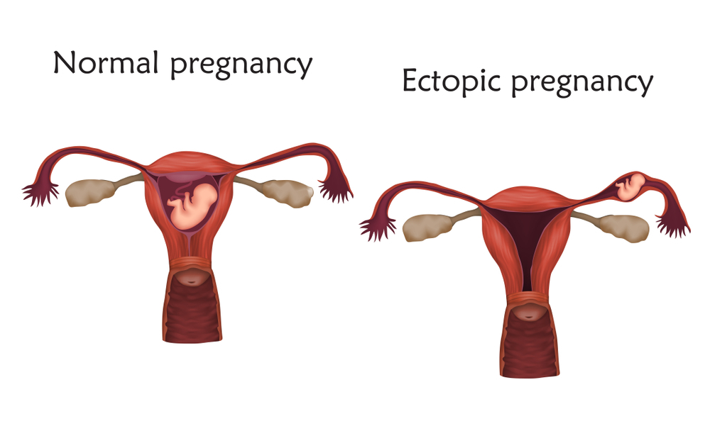 How To Avoid Ectopic Pregnancy With IVF