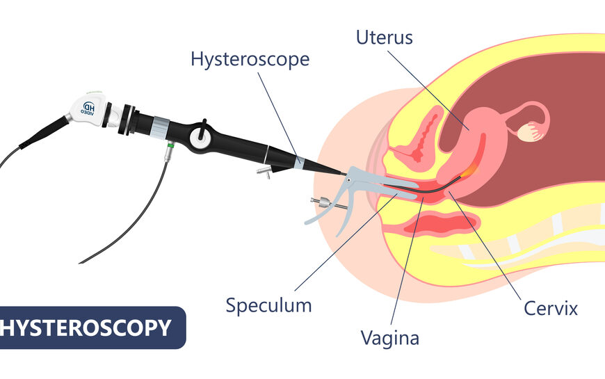 Pregnancy success after Hysteroscopy